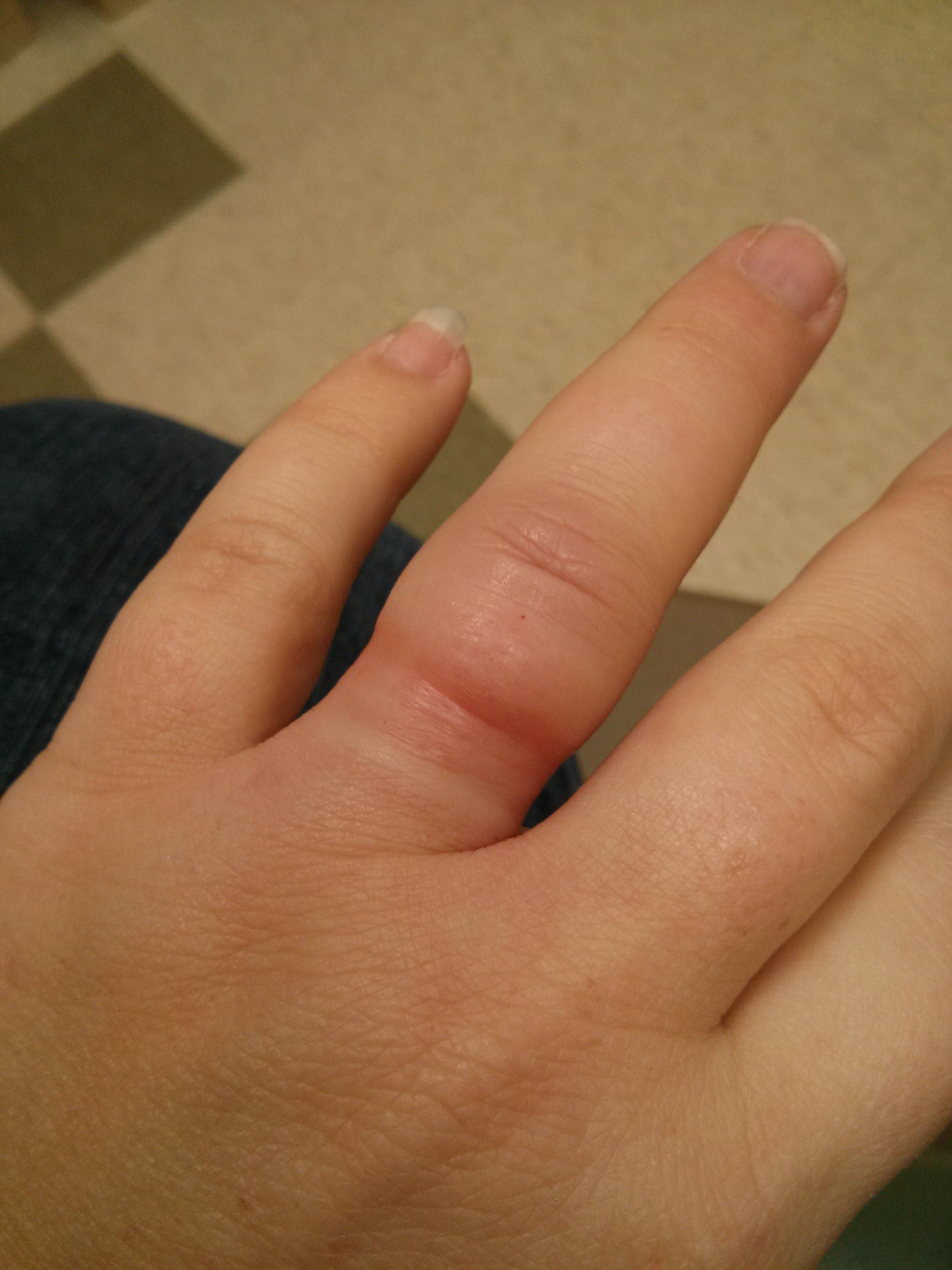 Wedding ring off swollen finger